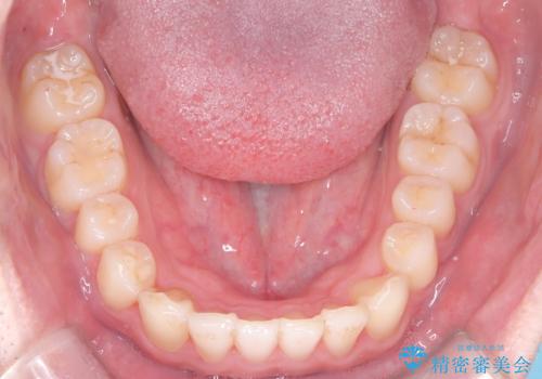 【インビザライン】前歯が出ているのを治したいの治療後