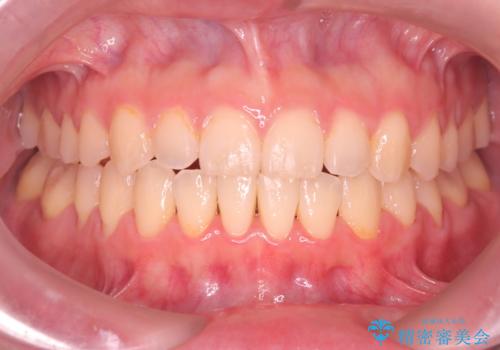 【ワイヤー矯正】一番後ろの奥歯でしか噛んでいないかみ合わせを治したいの症例 治療後