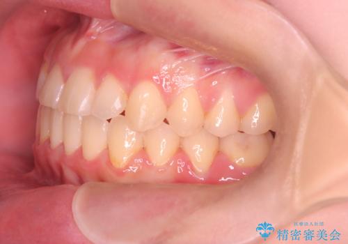 【ワイヤー矯正】一番後ろの奥歯でしか噛んでいないかみ合わせを治したいの治療後