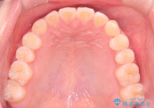 【ワイヤー矯正】一番後ろの奥歯でしか噛んでいないかみ合わせを治したいの治療後