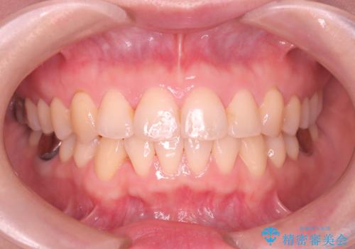 【ワイヤー矯正】がたつきを治したいの治療後