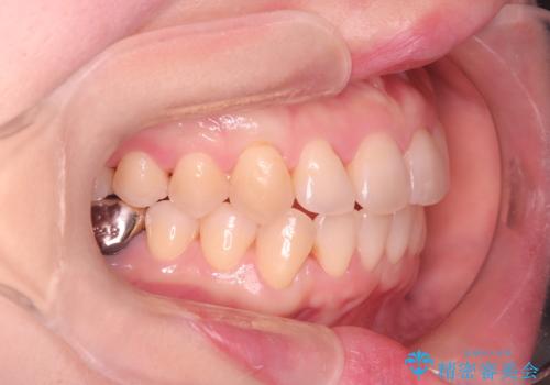 【ワイヤー矯正】がたつきを治したいの治療後