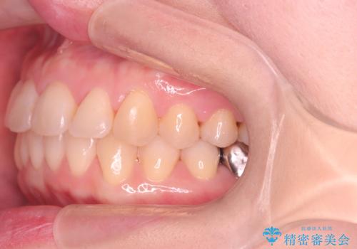 【ワイヤー矯正】がたつきを治したいの治療後