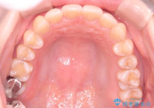 【ワイヤー矯正】がたつきを治したいの治療後