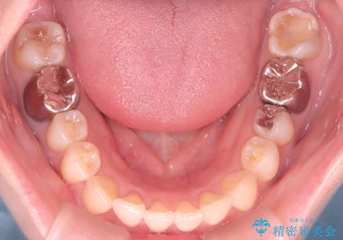 【ワイヤー矯正】がたつきを治したいの治療後