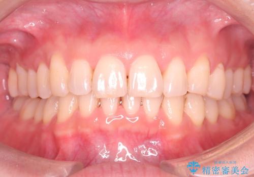 【インザライン】前歯の凸凹を治したい