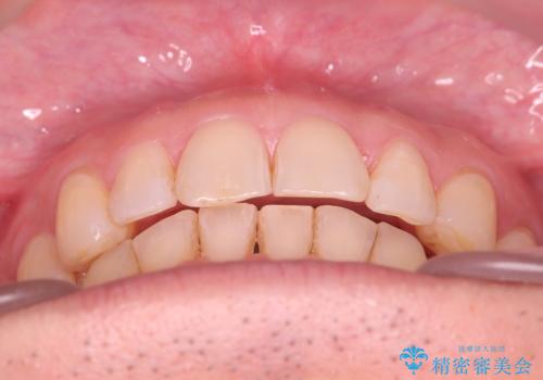 【インザライン】前歯の凸凹を治したいの治療後