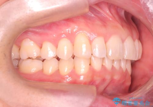 【インザライン】前歯の凸凹を治したいの治療後