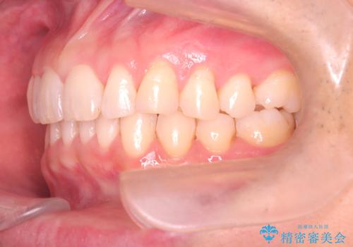 【インザライン】前歯の凸凹を治したいの治療後