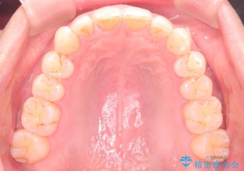 【インザライン】前歯の凸凹を治したいの治療後