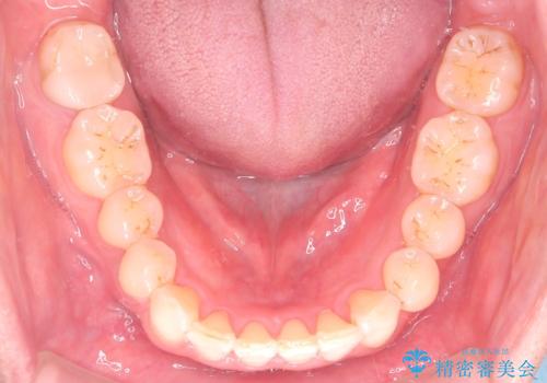 【インザライン】前歯の凸凹を治したいの治療後
