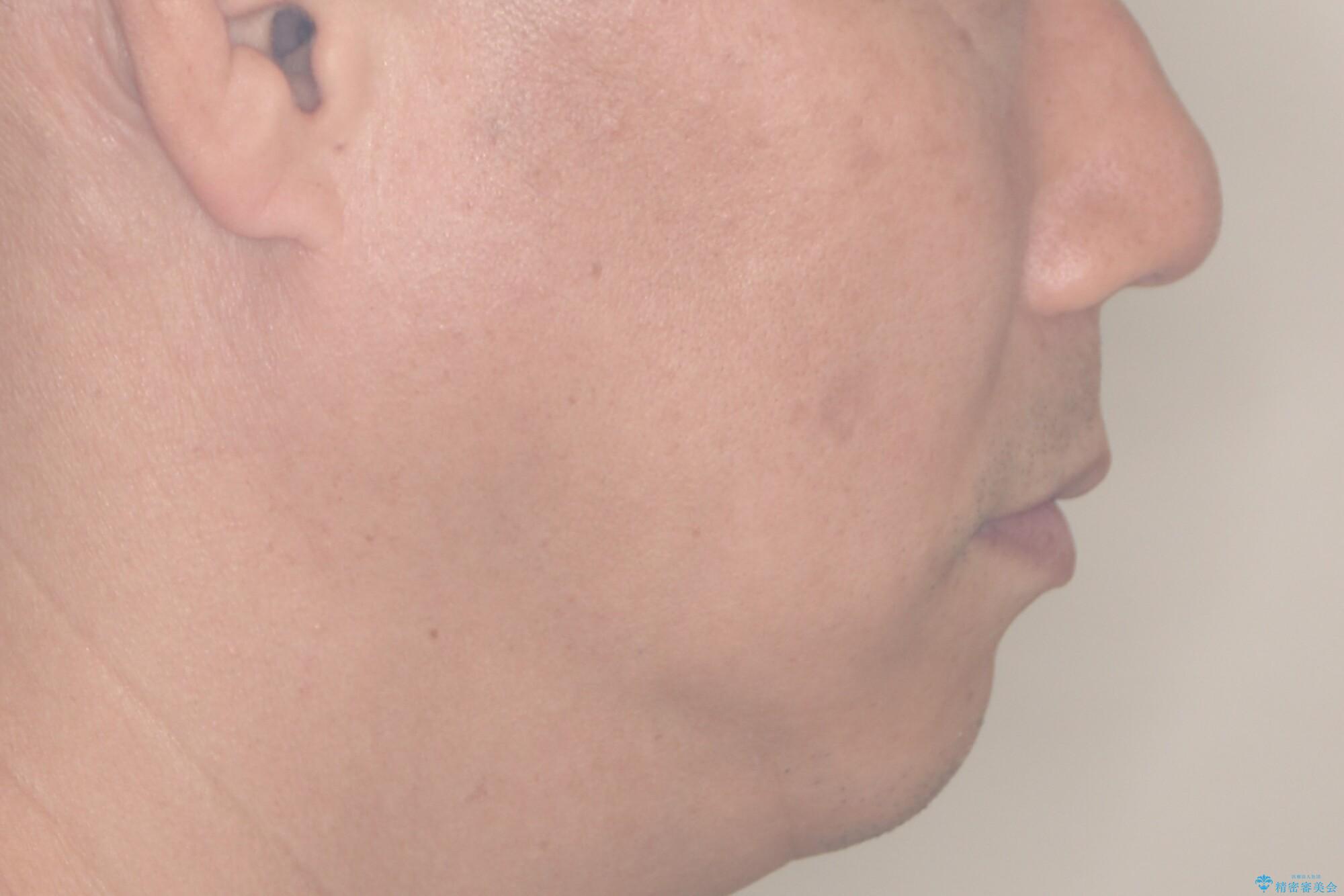 【インザライン】前歯の凸凹を治したいの治療後(顔貌)