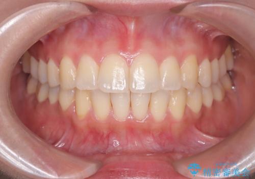 【ワイヤー矯正】軽度の叢生