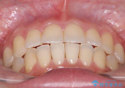 【ワイヤー矯正】軽度の叢生の治療後