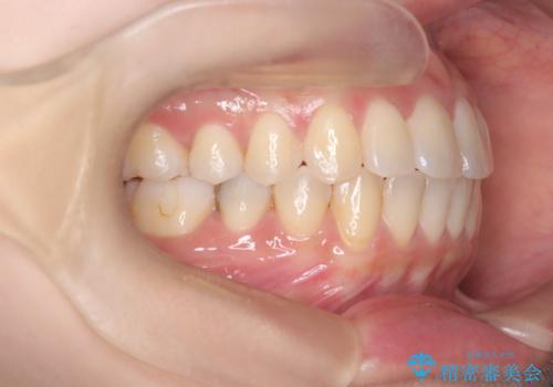 【ワイヤー矯正】軽度の叢生の治療後