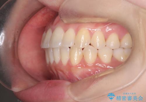 【ワイヤー矯正】軽度の叢生の治療後