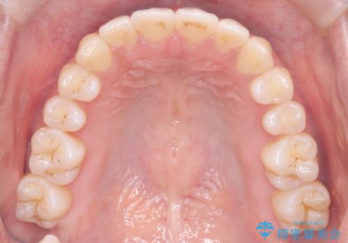 【ワイヤー矯正】軽度の叢生の治療後