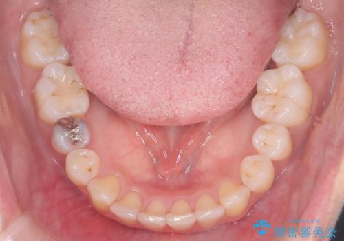 【ワイヤー矯正】軽度の叢生の治療後