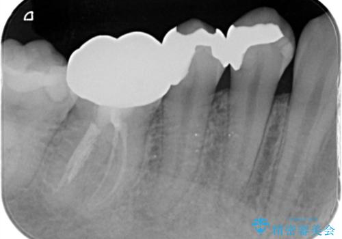歯の形が気になる セラミックでキレイな歯に!の治療前