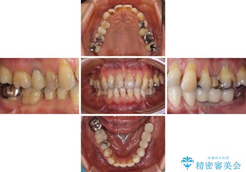 入れ歯を使いたくない 細い骨にインプラントを埋入した補綴治療の治療後