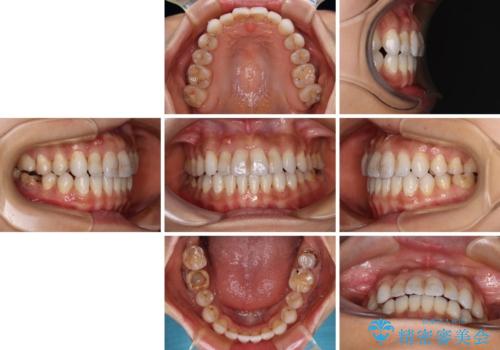 【モニター】開咬を治したい インビザラインによる矯正治療の治療後