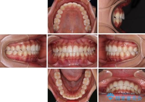 前歯のデコボコを治したい インビザライン・モデレートによる矯正治療の治療後