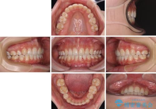 前に出ている上顎 抜歯矯正で唇を閉じやすくの治療後