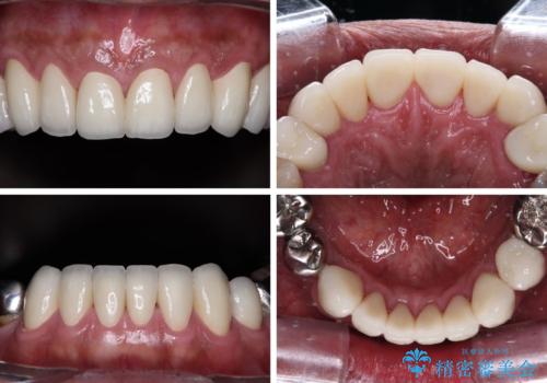 黄ばんだ前歯をきれいに 前歯の審美歯科治療の治療後