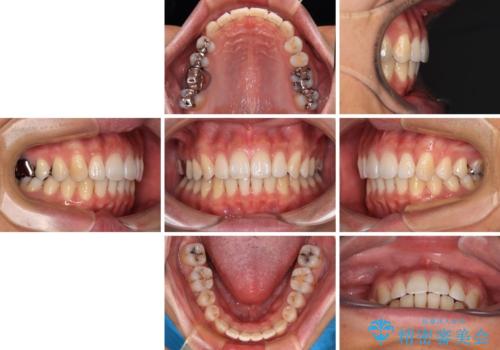 深い咬み合わせと前歯の隙間 ハーフリンガルによる矯正治療の治療後