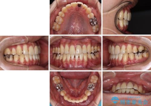 抜歯矯正で八重歯を改善 インビザライン矯正治療の治療後