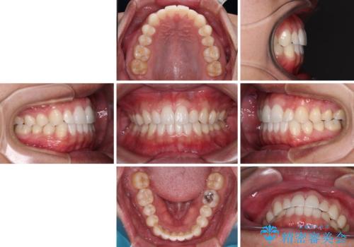 前歯のデコボコとクロスバイト インビザライン矯正治療の治療後
