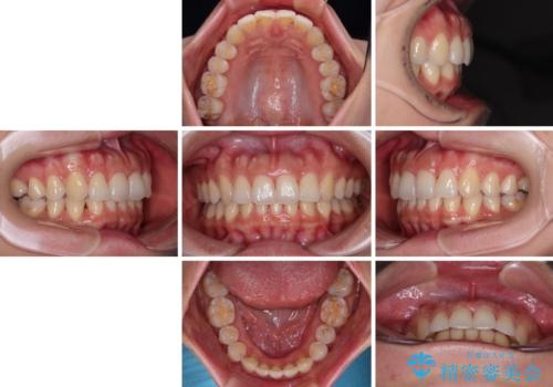 捻れた前歯をインビザラインで整えるの治療後