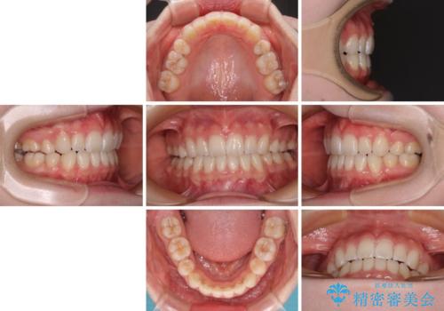 【モニター】口が閉じにくい 膨らんだ口元を抜歯矯正ですっきりとの治療後