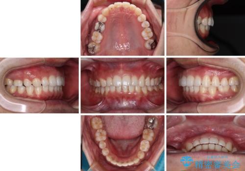 【モニター】前歯に隙間ができるほどのディープバイト ワイヤー装置で負担の少ない咬み合わせにの治療後