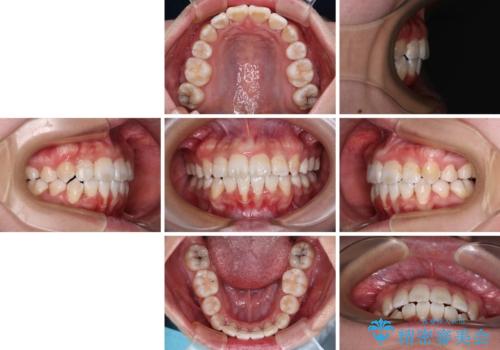 唇からはみ出るほど飛び出した前歯 ワイヤー装置による抜歯矯正の治療後