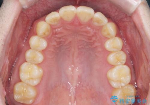 前歯のがたつきをなおしたい マウスピース矯正の治療後