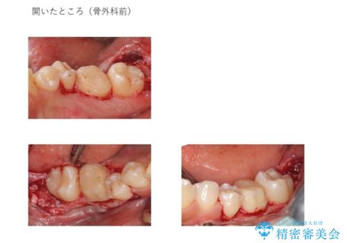 奥歯の高さがない 歯周外科処置で解決 (クラウンレングスニング)の治療中