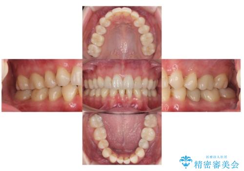 全体的な虫歯治療　銀歯をセラミックにの症例 治療後