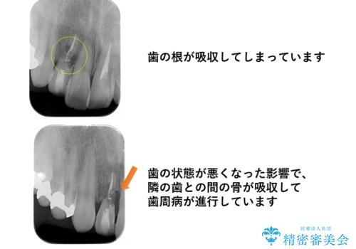 前歯をやむなく抜歯　ブリッジに　治療ついでに歯並びもよくの治療前