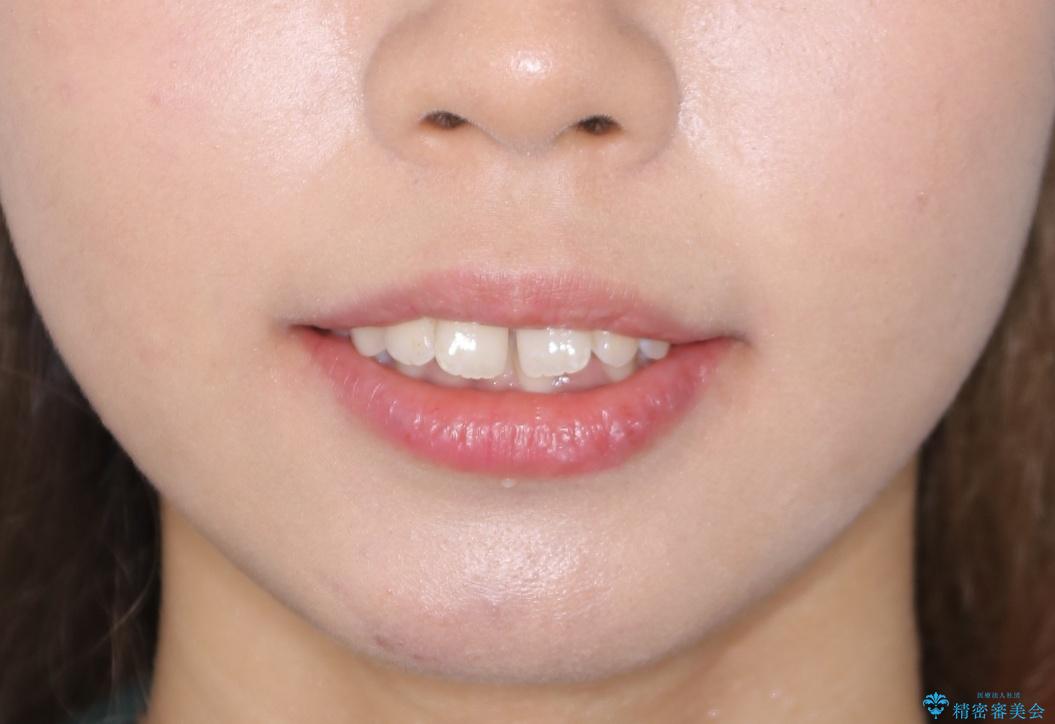 インビザライン矯正 歯を抜かずに出っ歯を改善!の治療前(顔貌)