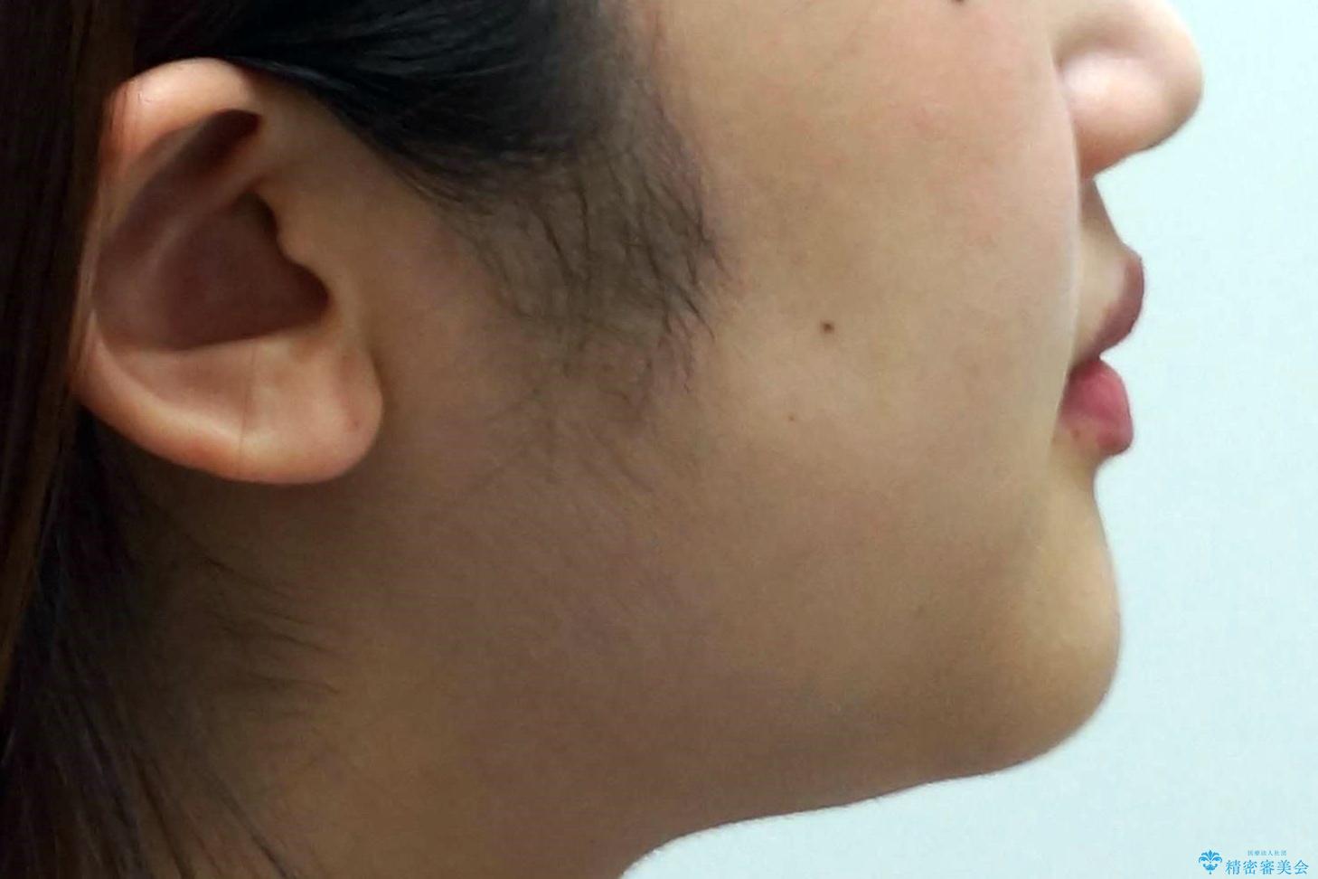 難症例 奥歯がかみ合っていない 歯並び矯正で別人にの治療後(顔貌)