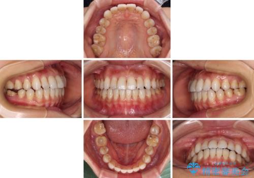 【モニター】開咬を治したい インビザラインによる矯正治療の治療中