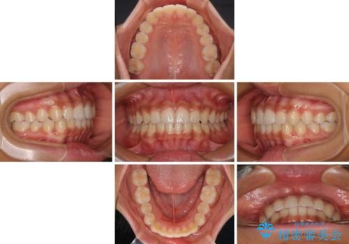 前歯のデコボコを治したい インビザライン・モデレートによる矯正治療の治療中