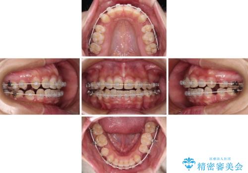 前に出ている上顎 抜歯矯正で唇を閉じやすくの治療中