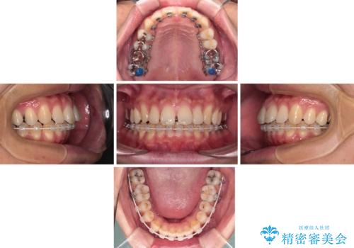 深い咬み合わせと前歯の隙間 ハーフリンガルによる矯正治療の治療中