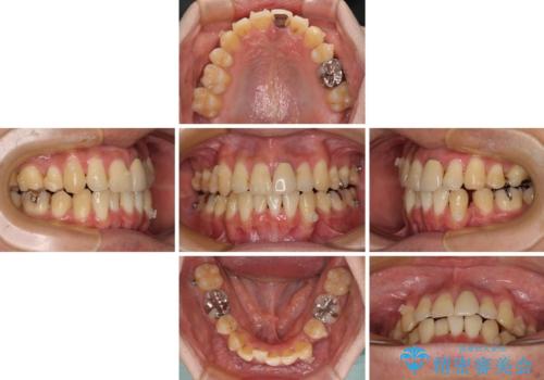 抜歯矯正で八重歯を改善 インビザライン矯正治療の治療中