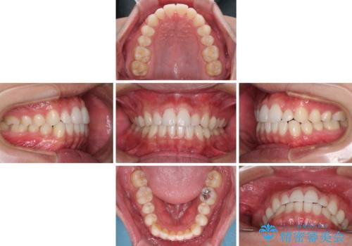 前歯のデコボコとクロスバイト インビザライン矯正治療の治療中