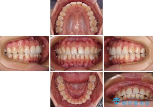 捻れた前歯をインビザラインで整えるの治療中