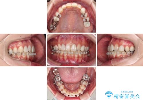 大きなむし歯と欠損をセラミックに 部分矯正を併用した総合歯科治療の治療中