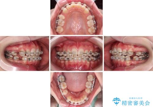 【モニター】口が閉じにくい 膨らんだ口元を抜歯矯正ですっきりとの治療中